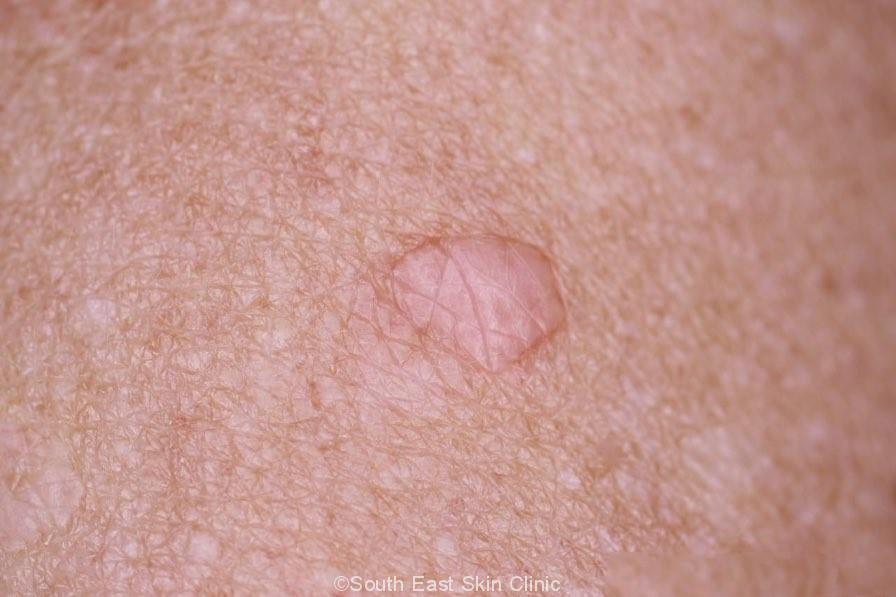 Skin Cancer Spots On Arm