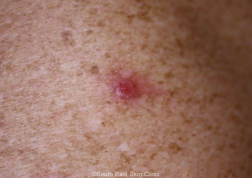 BCC (Basal Cell Carcinoma)