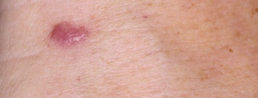 BCC (Basal Cell Carcinoma)