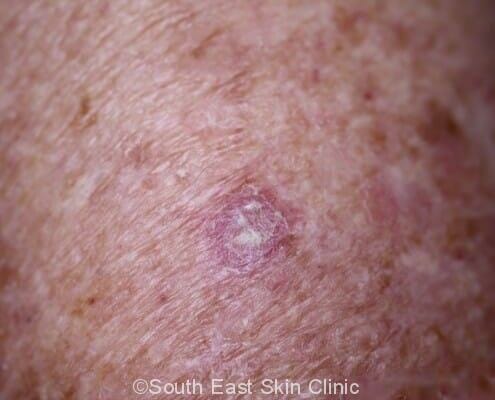 Elevated skin lesions