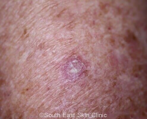 SCC (Squamous Cell Carcinoma) - Skin Cancer Clinic Brisbane