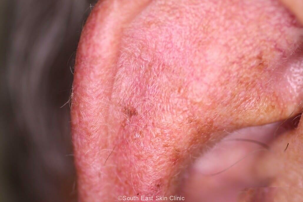 Brown Spots Inside Mouth