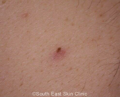 Combined Nevus - South East Skin Clinic