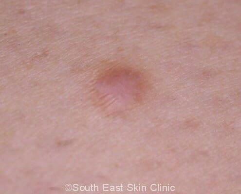 Firm Skin Lesions