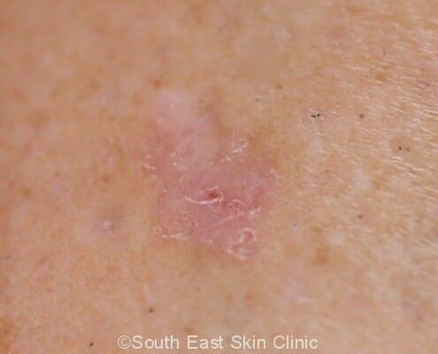 Elevated skin lesions