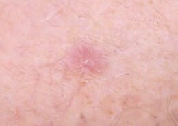 BCC (Basal Cell Carcinoma)