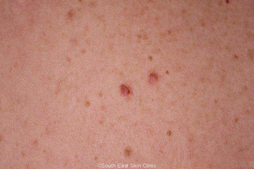 atypical-mole-south-east-skin-clinic