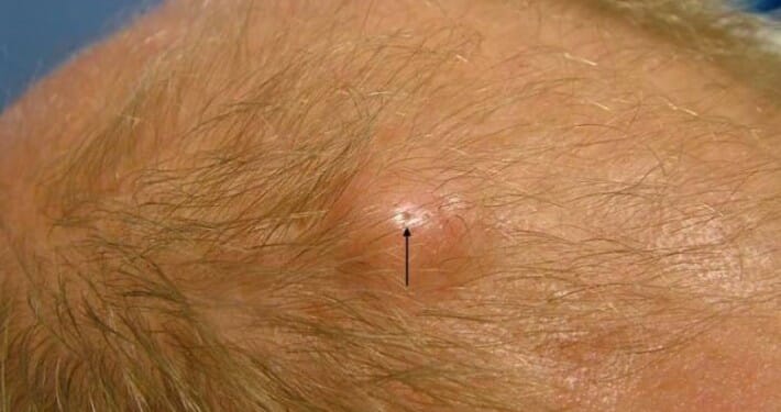 sebaceous-cyst-south-east-skin-clinic