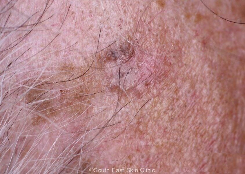 BCC (Basal Cell Carcinoma)