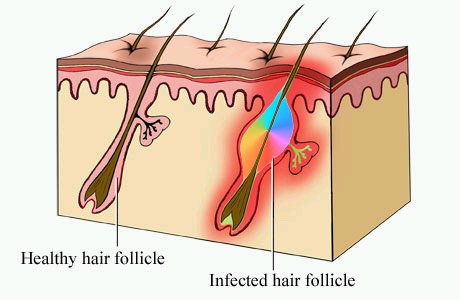 Folliculitis A Term Many Australians Are Familiar With But Why