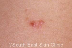 Molluscum Contagiosum