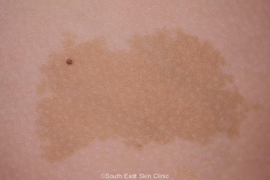 Cafe au Lait South East Skin Clinic