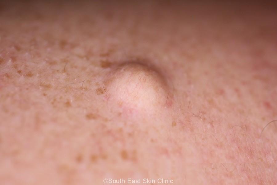 Vulvar Sebaceous Cyst