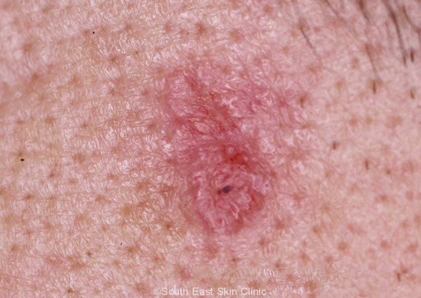 BCC (Basal Cell Carcinoma)