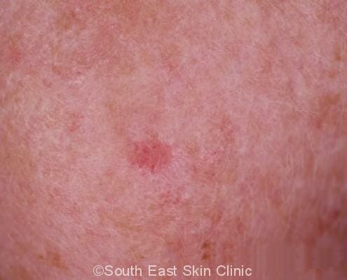 Iec (intraepidermal Carcinoma) - South East Skin Clinic