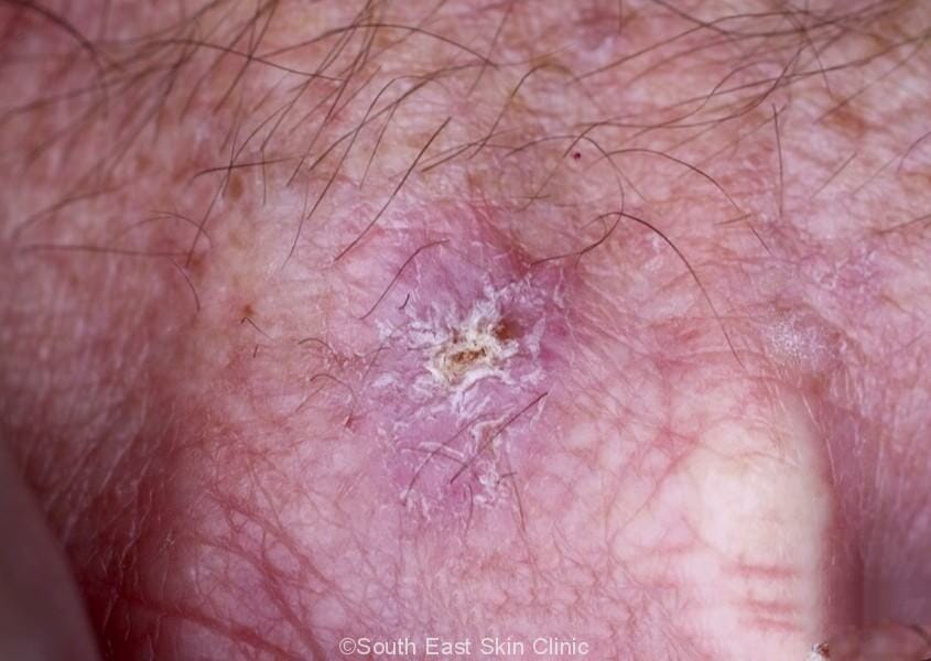 BCC (Basal Cell Carcinoma)