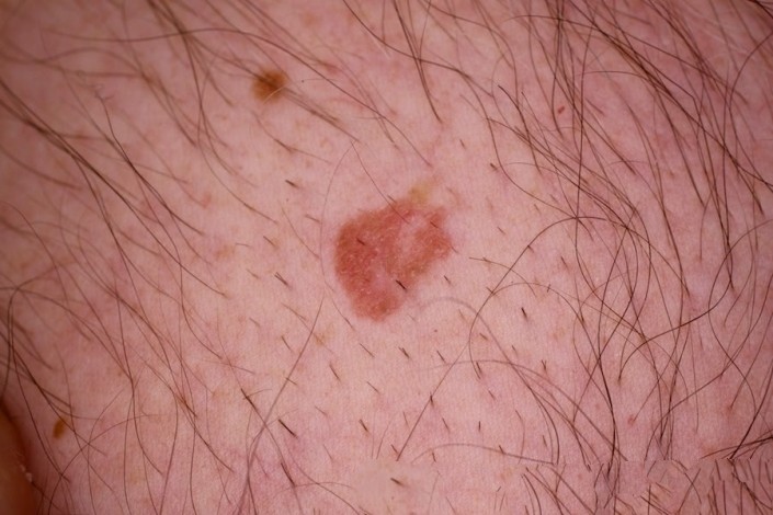 IEC (Intraepidermal Carcinoma) - South East Skin Clinic