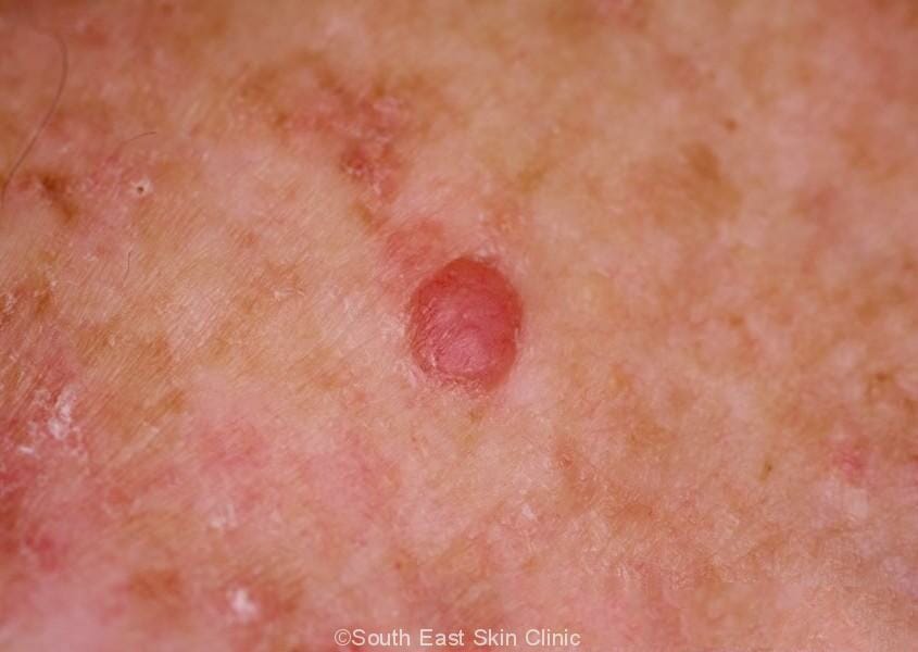 BCC (Basal Cell Carcinoma)